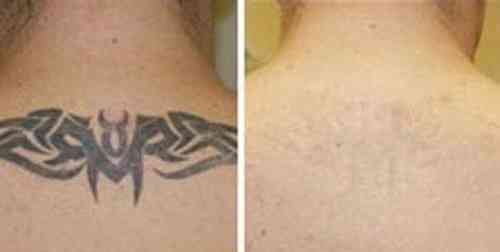 Удаление татуировок и татуажа 