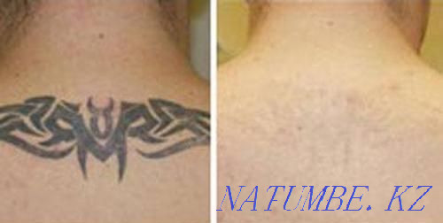 Removal of tattoos and permanent make-up  - photo 3