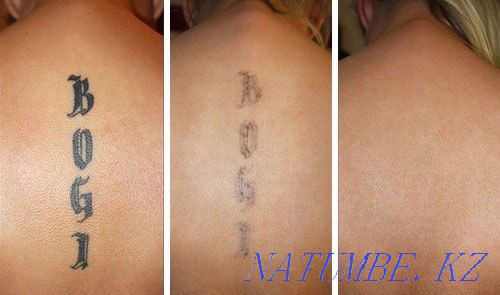 Removal of tattoos and permanent make-up  - photo 1