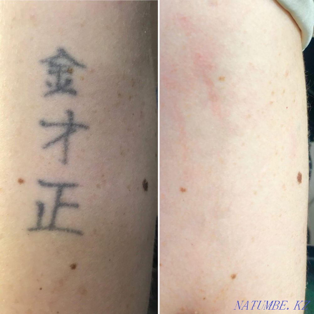 Removal of tattoos and permanent make-up  - photo 2
