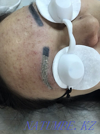 Promotion. 3500 instead of 7000 Removal of old Tattoo. New generation laser. Oral - photo 6
