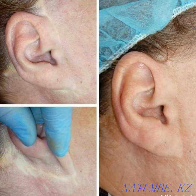 Tattoo medical areola, scars, scars, vitiligo, alopecia Almaty - photo 4
