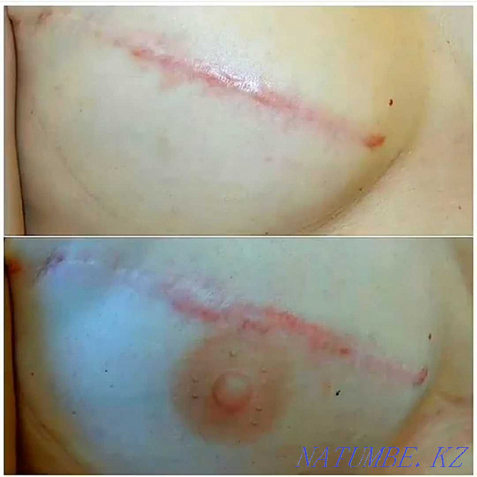 Tattoo medical areola, scars, scars, vitiligo, alopecia Almaty - photo 7