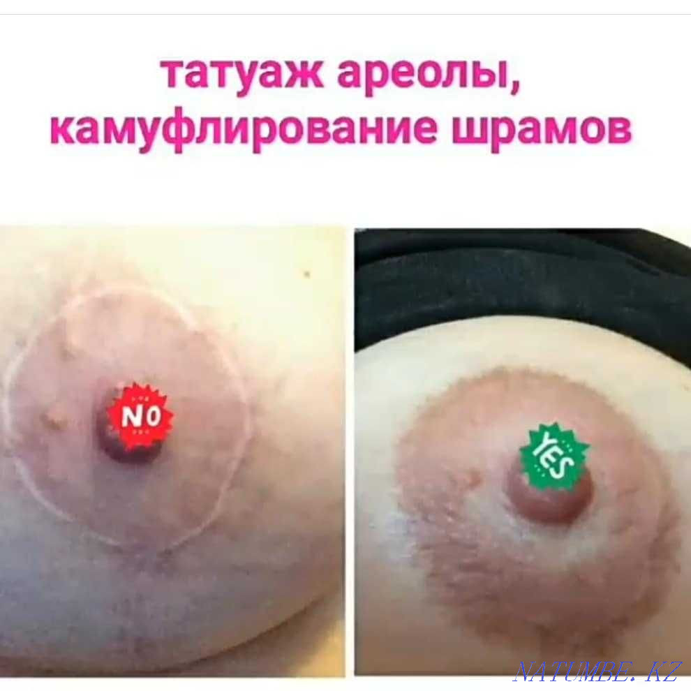 Татуаж медицинский ареол, шрамов, рубцов, витилиго, алопеции Алматы - изображение 2