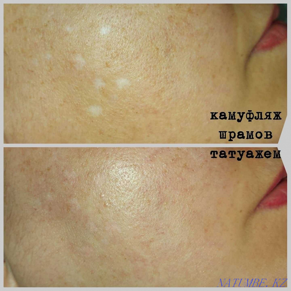 Татуаж медицинский ареол, шрамов, рубцов, витилиго, алопеции Алматы - изображение 5