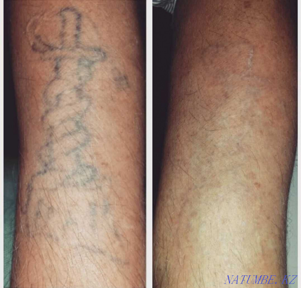 Перманентный татуаж, лазерное удаление, карбoновый пилинг, BrowBar Алматы - изображение 6