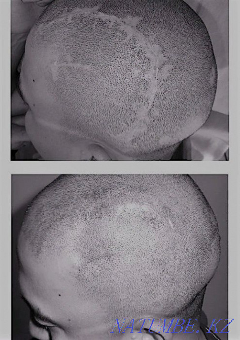 Перманентный татуаж, лазерное удаление, карбoновый пилинг, BrowBar Алматы - изображение 2