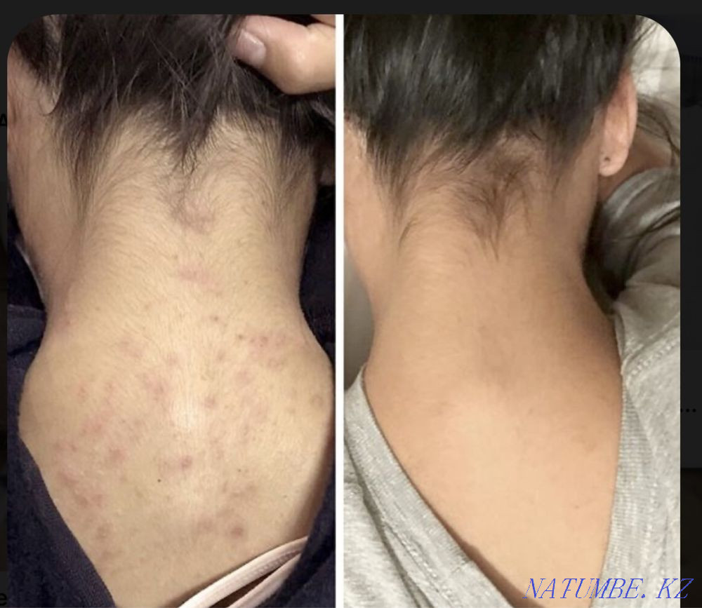 Tattoo removal 3500 Almaty - photo 6