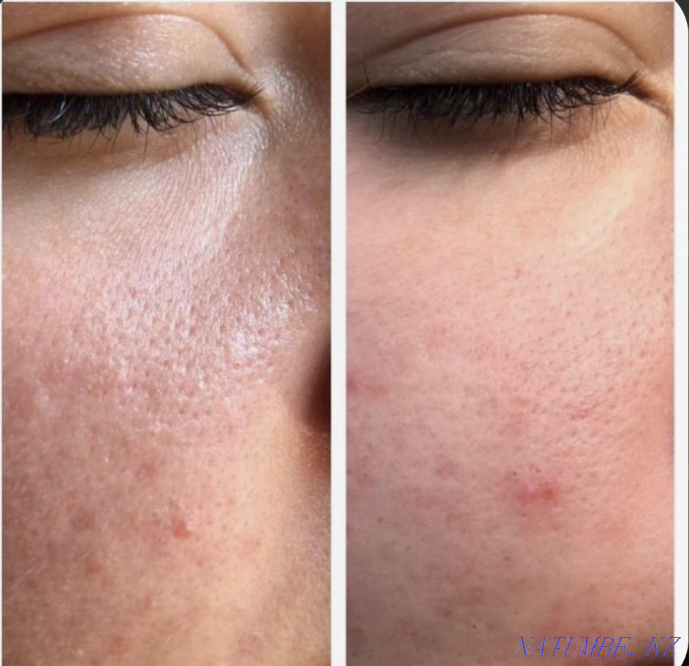 Tattoo removal 3500 Almaty - photo 5