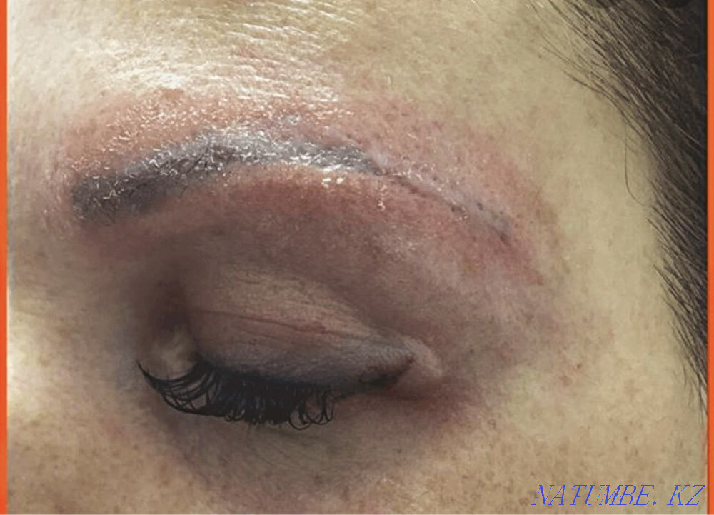 Tattoo removal 3500 Almaty - photo 4