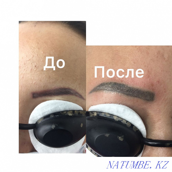 Tattoo removal Almaty - photo 1