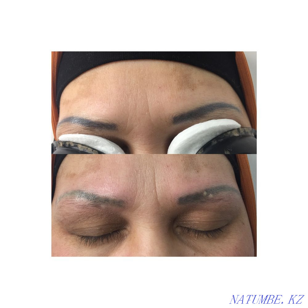 Tattoo removal Almaty - photo 2