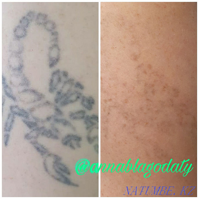 Laser tattoo and tattoo removal Karagandy - photo 5