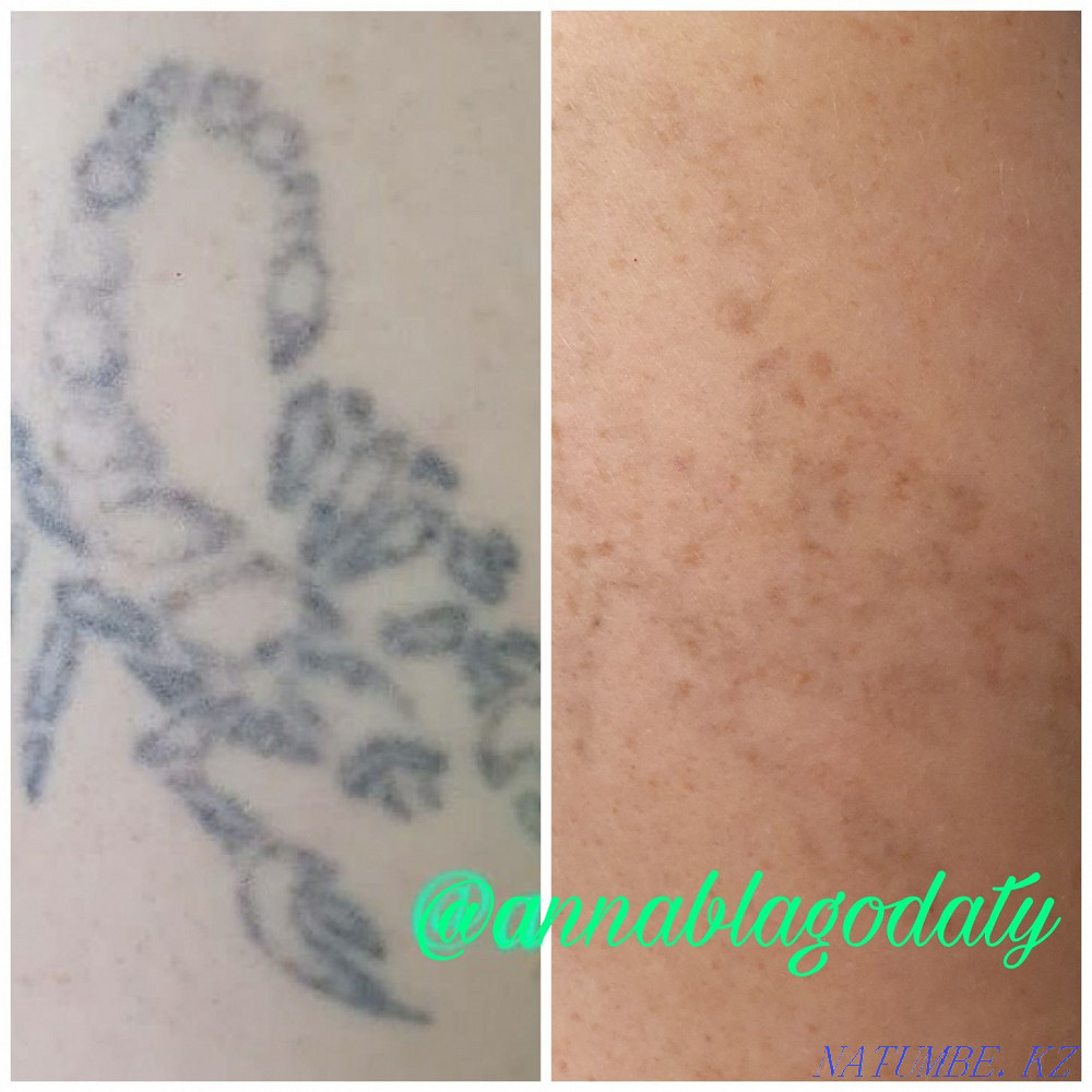 Лазерное удаление тату и татуажа Караганда - изображение 5