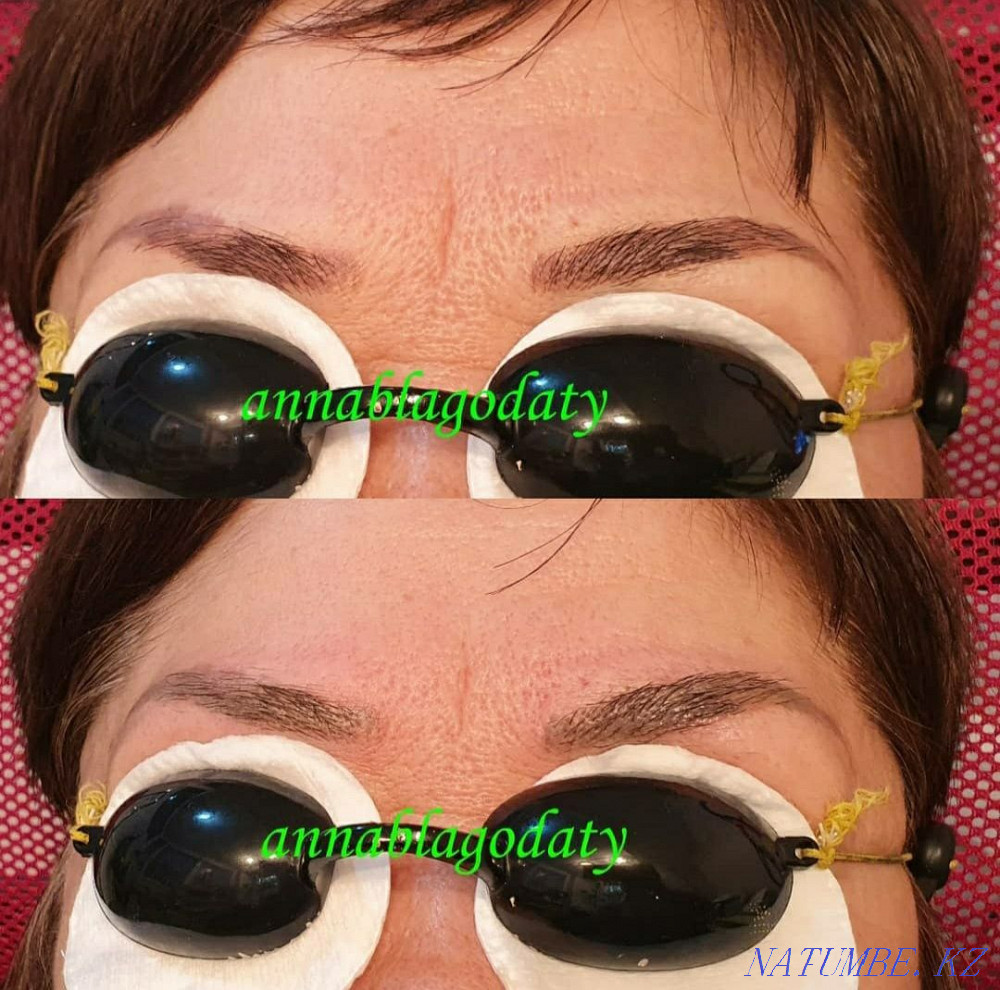 Лазерное удаление тату и татуажа Караганда - изображение 2