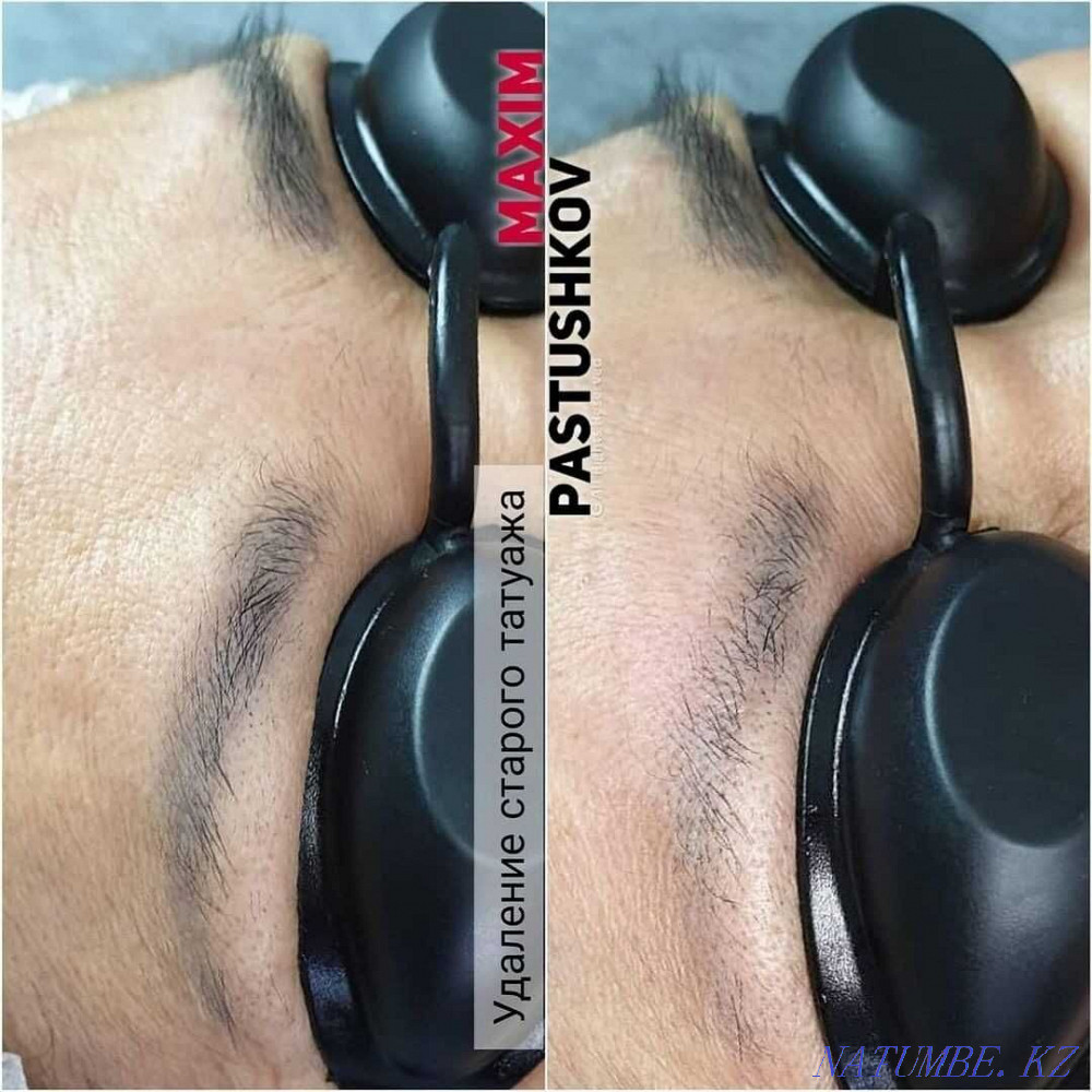 removal of old tattoo. Astana - photo 4