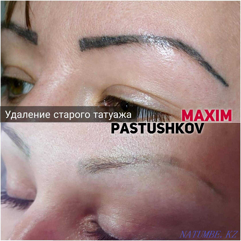removal of old tattoo. Astana - photo 5