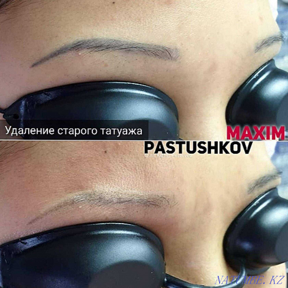 removal of old tattoo. Astana - photo 1