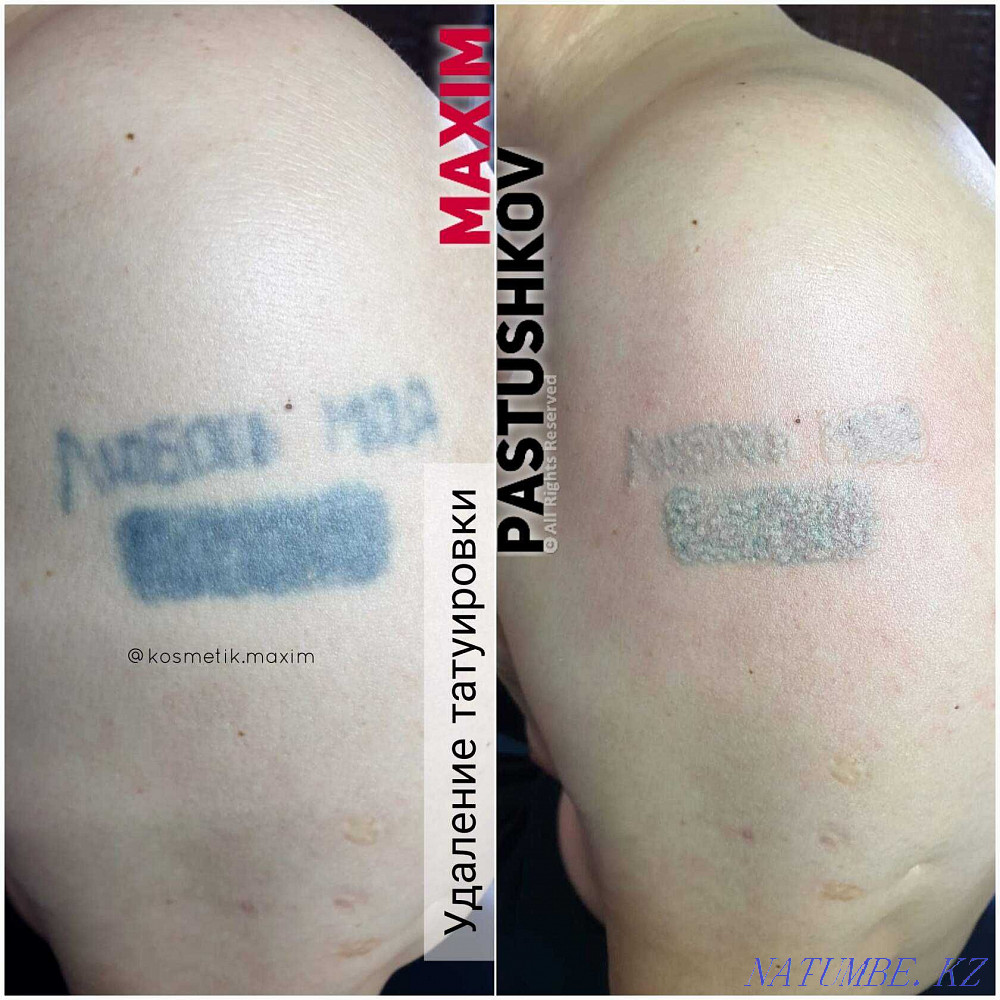 removal of old tattoo. Astana - photo 3