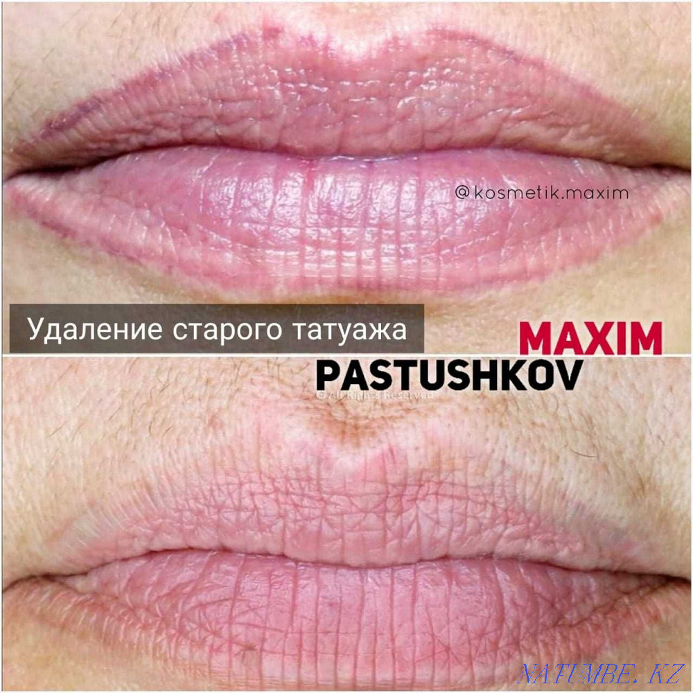 removal of old tattoo. Astana - photo 2