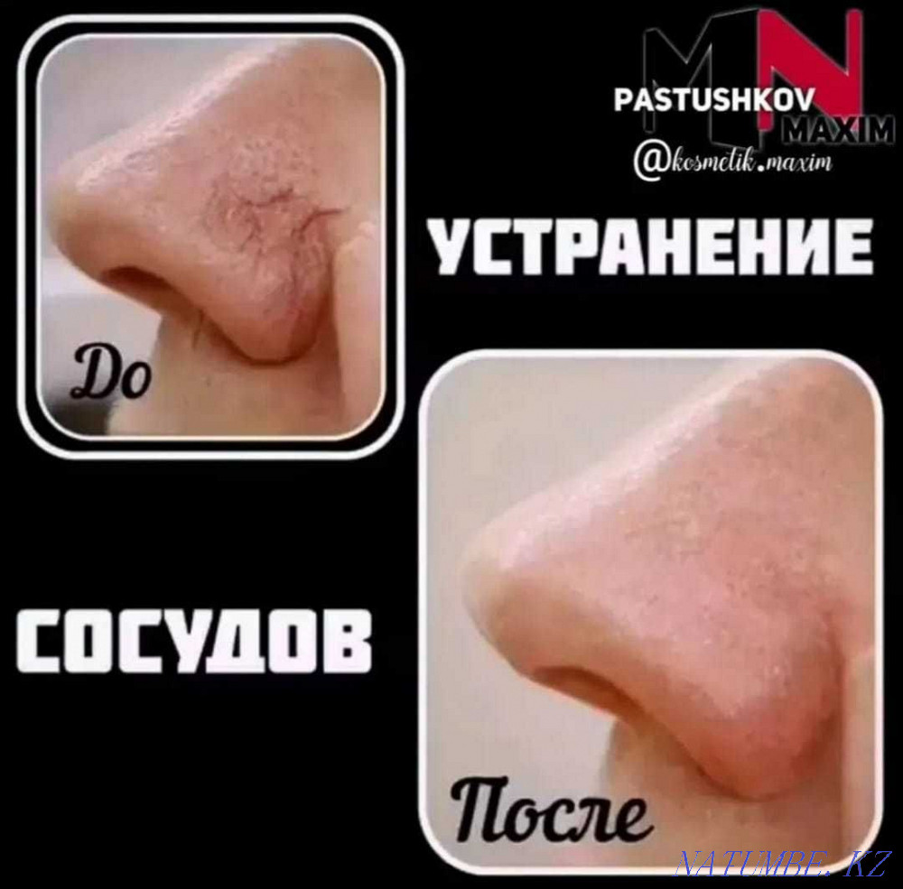 removal of old tattoo. Astana - photo 6