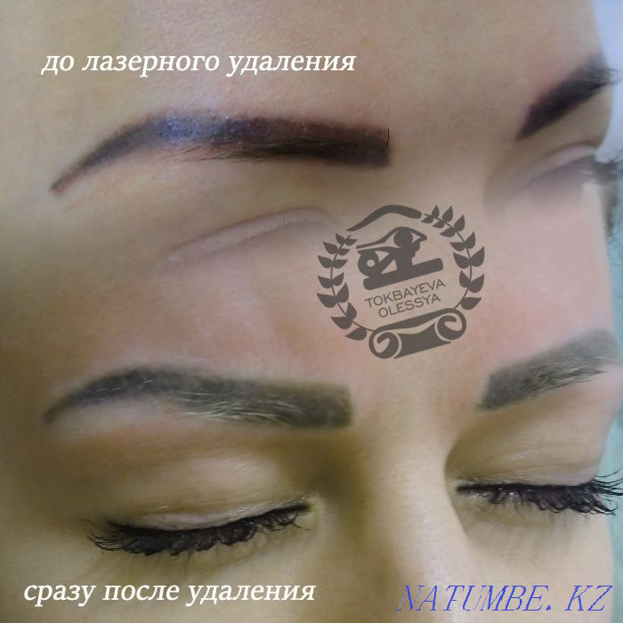 Удаление татуажа лазером, ремувером, от3500тг. Алматы - изображение 7
