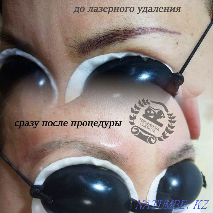 Удаление татуажа лазером, ремувером, от3500тг. Алматы - изображение 8