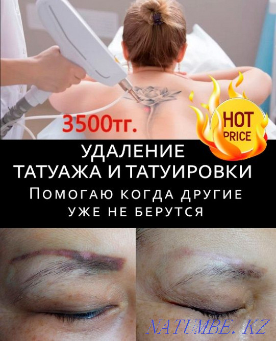 Удаление татуажа лазером, ремувером, от3500тг. Алматы - изображение 1