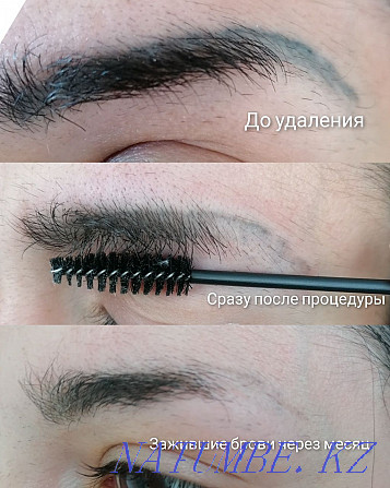 Laser tattoo removal! Kostanay - photo 6