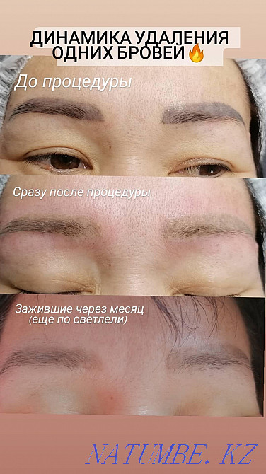 Laser tattoo removal! Kostanay - photo 1