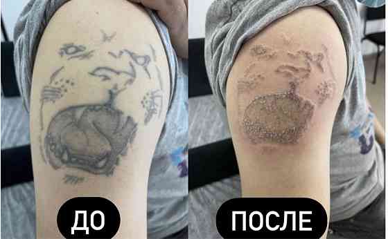 Лазерное удаление тату, татуажа удаление ремувером Karagandy