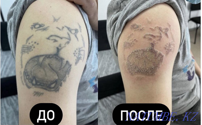 Татуировканы лазермен алып тастау, кетіргішпен татуировканы алып тастау  Қарағанды - изображение 6