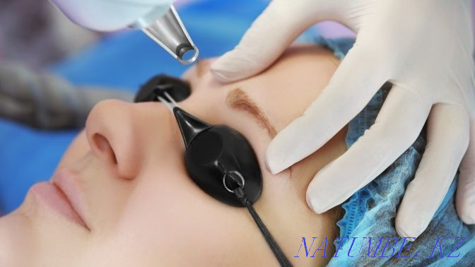 Laser tattoo removal, tattoo removal with a remover Karagandy - photo 2