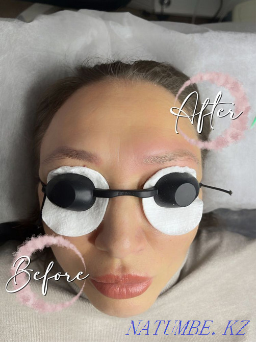 Laser tattoo removal, tattoo removal with a remover Karagandy - photo 4