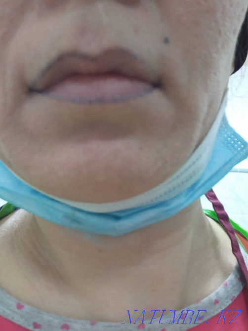 Laser tattoo removal, tattoo removal with a remover Karagandy - photo 7