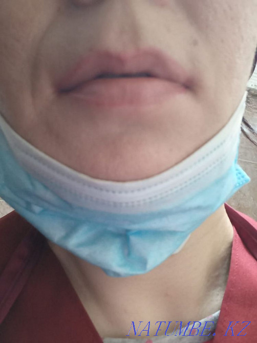 Laser tattoo removal, tattoo removal with a remover Karagandy - photo 8