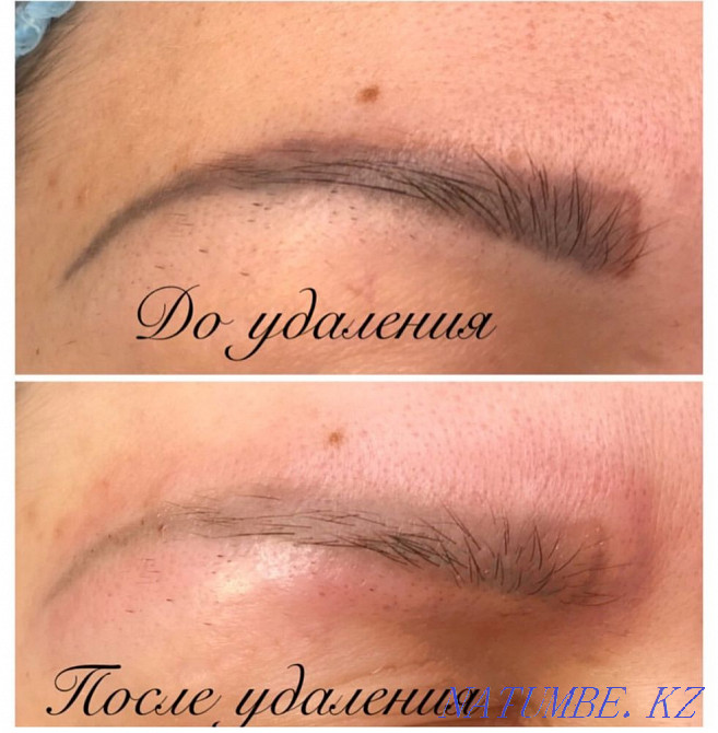 Удаление Татуажа ремувером Караганда - изображение 2