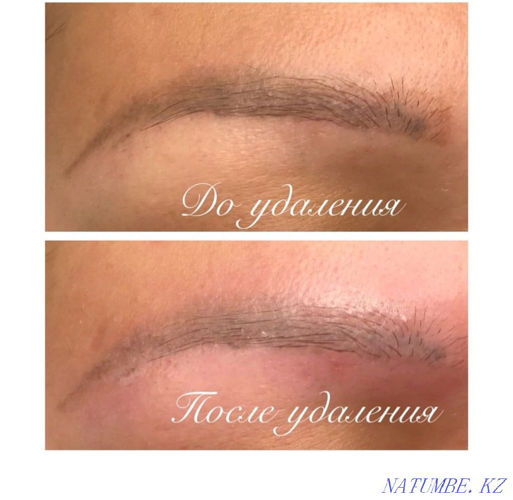 Удаление Татуажа ремувером Караганда - изображение 3