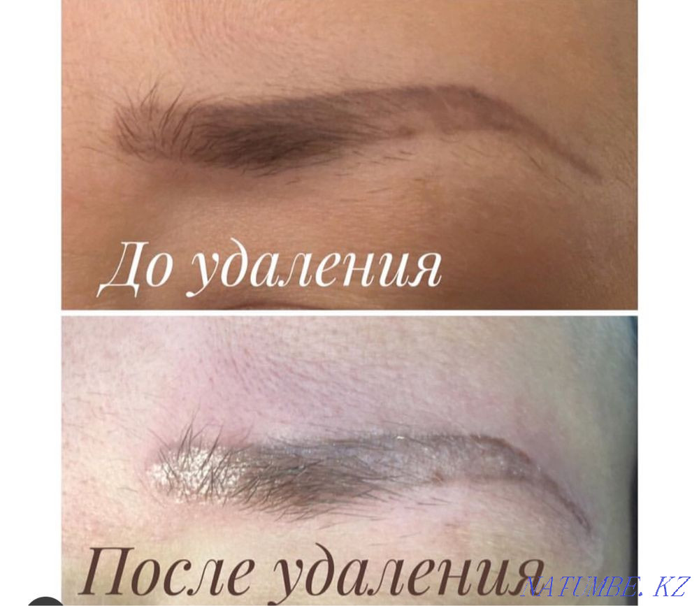 Удаление Татуажа ремувером Караганда - изображение 4