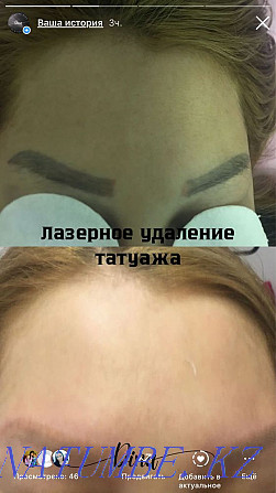 Татуировканы лазермен кетіру 3000  Астана - изображение 1