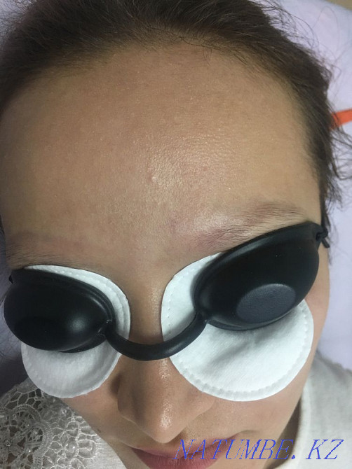 Удаление татуажа лазером 3000 Астана - изображение 4