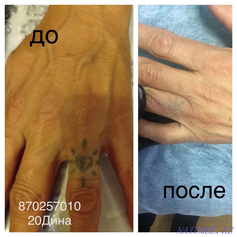 Удаление татуажа лазером 3000 Астана - изображение 3