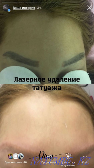 Удаление татуажа лазером 3000 Астана - изображение 1
