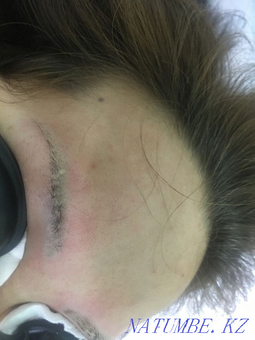 Удаление татуажа лазером 3000 Астана - изображение 5