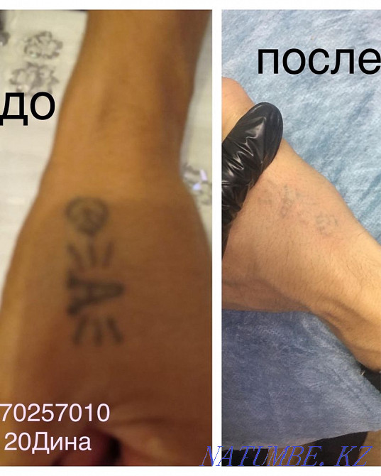 Удаление татуажа лазером 3000 Астана - изображение 2