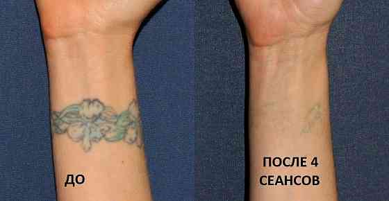 Удаление татуажа бровей губ татуировок Лазером Каскелен