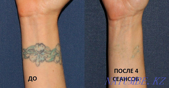 Удаление татуажа бровей губ татуировок Лазером Каскелен - изображение 2
