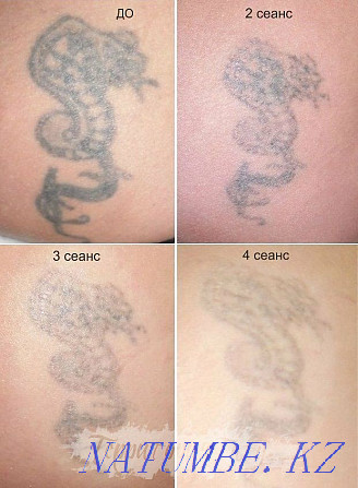 Удаление татуажа бровей губ татуировок Лазером Каскелен - изображение 4