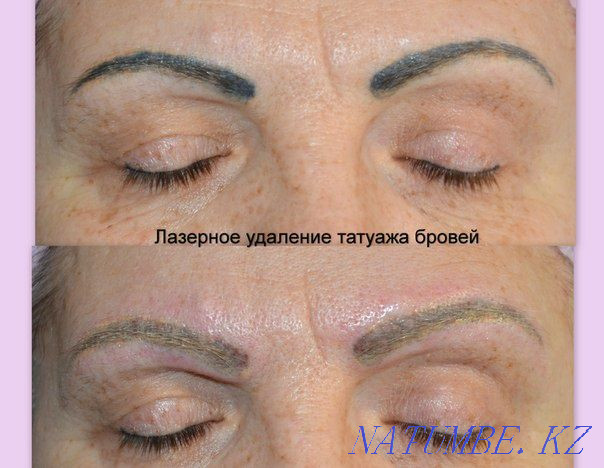 Eyebrow lip tattoo removal with laser Qaskeleng - photo 1