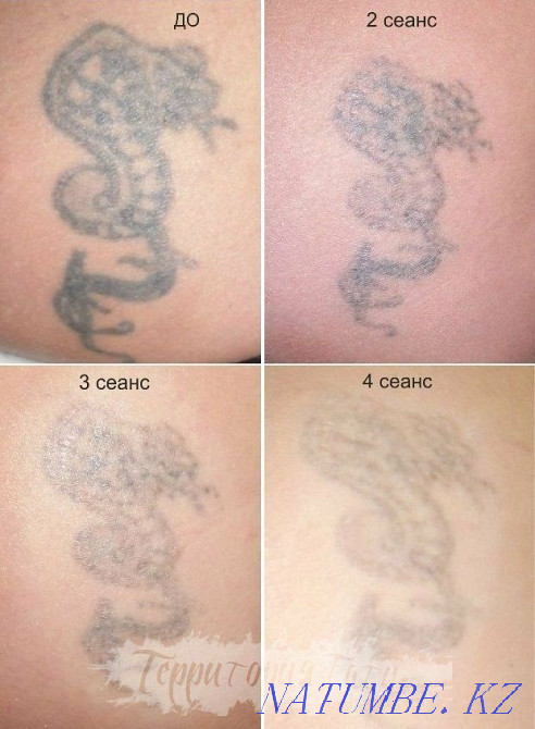 Eyebrow lip tattoo removal with laser Qaskeleng - photo 4